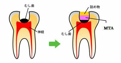 MTAセメントのイメージ