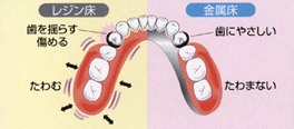 保険外の入れ歯の説明