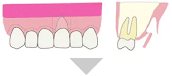 歯肉の移植のイメージ