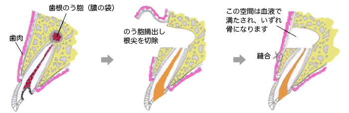 歯根端切除術の説明