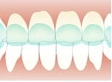 マウスピースホワイトニングのイメージ