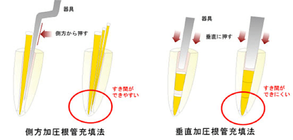 垂直加圧方式の説明